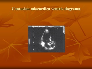 Contusion miocardica ventriculograma
 