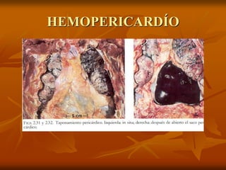 HEMOPERICARDÍO
 