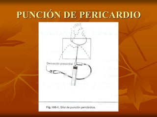 PUNCIÓN DE PERICARDIO
 