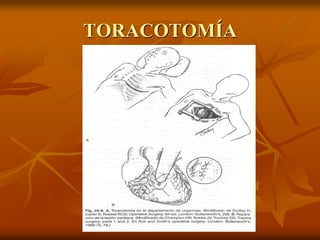 TORACOTOMÍA
 