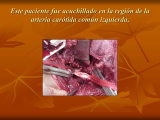 Este paciente fue acuchillado en la región de la
arteria carótida común izquierda,
 