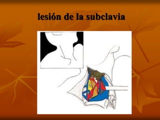 lesión de la subclavia
 