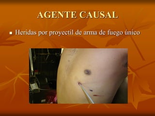 AGENTE CAUSAL
 Heridas por proyectil de arma de fuego único
 