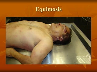 Equimosis
 