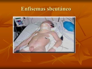 Enfisemas sbcutáneo
 