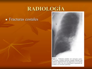RADIOLOGÍA
 Fracturas costales
 