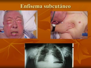 Enfisema subcutáneo
 