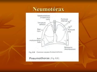 Neumotórax
 