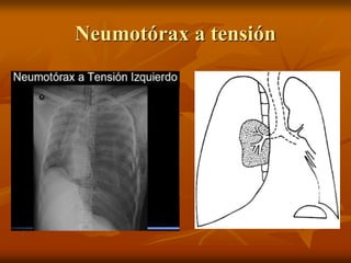 Neumotórax a tensión
 