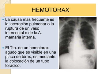 HEMOTORAX
 La causa mas frecuente es
la laceración pulmonar o la
ruptura de un vaso
intercostal o de la A.
mamaria interna.
 El Tto. de un hemotarax
agudo que es visible en una
placa de tórax, es mediante
la colocación de un tubo
torácico.
 