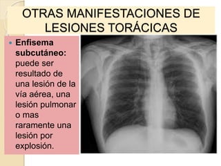 OTRAS MANIFESTACIONES DE
LESIONES TORÁCICAS
 Enfisema
subcutáneo:
puede ser
resultado de
una lesión de la
vía aérea, una
lesión pulmonar
o mas
raramente una
lesión por
explosión.
 