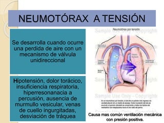 NEUMOTÓRAX A TENSIÓN
Causa mas común ventilación mecánica
con presión positiva.
Se desarrolla cuando ocurre
una perdida de aire con un
mecanismo de válvula
unidireccional
Hipotensión, dolor torácico,
insuficiencia respiratoria,
hiperresonanacia a
percusión, ausencia de
murmullo vesicular, venas
de cuello ingurgitadas,
desviación de tráquea
 