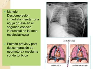 Manejo:
Descompresión
inmediata insertar una
aguja gruesa en el
segundo espacio
intercostal en la línea
medioclavicular
 Pulmón previo y post
descompresión de
neumotorax mediante
sonda torácica
 
