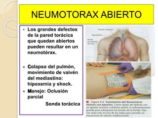 NEUMOTORAX ABIERTO
 Los grandes defectos
de la pared torácica
que quedan abiertos
pueden resultar en un
neumotórax.
 Colapso del pulmón,
movimiento de vaivén
del mediastino:
hipoxemia y shock.
 Manejo: Oclusión
parcial
Sonda torácica
 