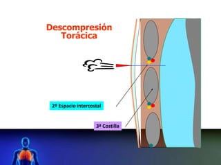 2º Espacio intercostal
3ª Costilla
Descompresión
Torácica
 