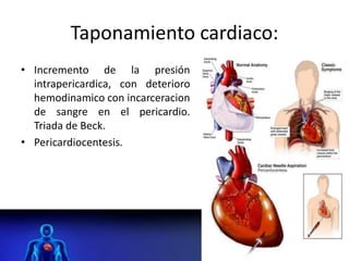 Taponamiento cardiaco:
• Incremento de la presión
intrapericardica, con deterioro
hemodinamico con incarceracion
de sangre en el pericardio.
Triada de Beck.
• Pericardiocentesis.
 