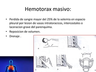 Hemotorax masivo:
• Perdida de sangre mayor del 25% de la volemia en espacio
pleural por lesion de vasos intratoracicos, intercostales o
laceracion grave del parenquima.
• Reposicion de volumen.
• Drenaje .
 