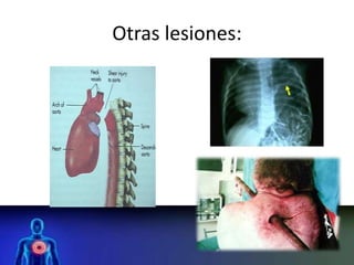 Otras lesiones:
 