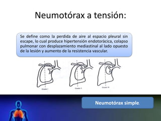 Neumotórax a tensión:
Se define como la perdida de aire al espacio pleural sin
escape, lo cual produce hipertensión endotoràcica, colapso
pulmonar con desplazamiento mediastinal al lado opuesto
de la lesión y aumento de la resistencia vascular.
Neumotórax simple.
 