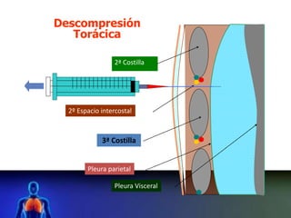 2º Espacio intercostal
2ª Costilla
3ª Costilla
Pleura parietal
Pleura Visceral
Descompresión
Torácica
 