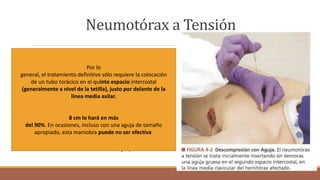 Neumotórax a Tensión
Diferencia. Taponamiento cardiaco. La diferenciación
se puede hacer por la presencia de hiperresonancia a la
percusión, desviación de la tráquea y ausencia de ruidos
respiratorios en el hemitórax afectado, todos signos típicos
del neumotórax a tensión.
Tx
Una aguja gruesa en el segundo espacio intercostal,
en la línea media-clavicular del hemitórax afectado
Esta maniobra, si es efectiva,
convierte la lesión en un neumotórax simple,
Por lo
general, el tratamiento definitivo sólo requiere la colocación
de un tubo torácico en el quinto espacio intercostal
(generalmente a nivel de la tetilla), justo por delante de la
línea media axilar.
8 cm lo hará en más
del 90%. En ocasiones, incluso con una aguja de tamaño
apropiado, esta maniobra puede no ser efectiva.
 