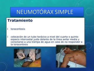 NEUMOTÓRAX SIMPLE
Tratamiento
🞇 toracentesis
🞇 colocación de un tubo torácico a nivel del cuarto o quinto
espacio intercostal justo delante de la línea axilar media y
conectarse a una trampa de agua en caso de no responder a
la toracentesis
 