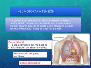 NEUMOTÓRAX A TENSIÓN
🞇 se produce por mecanismo de una válvula unilateral
producto del trauma que permite la entrada de aire al
espacio pleural pero no la salida aumentando la presión
positiva intrapleural hasta colapsar el pulmón
Curso natural
• desplazamiento del mediastino
• Disminución del retorno venoso
Disminución del gasto
cardiaco
Shock obstructivo
 
