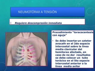NEUMOTÓRAX A TENSIÓN
🞇 Requiere descompresión inmediata
Procedimiento “toracocentesis
con aguja”
• Se debe insertarun cateter
avocath en el 2do espacio
intercostal sobre la linea
media clavicular del
hemitorax afectado, en
caso de no dar resultados
se debe colocar un tubo
torácico en el 5to espacio
intercostal anterior a la
línea media axilar
 