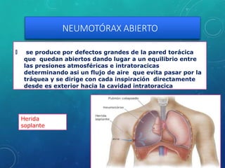 NEUMOTÓRAX ABIERTO
🞇 se produce por defectos grandes de la pared torácica
que quedan abiertos dando lugar a un equilibrio entre
las presiones atmosféricas e intratoracicas
determinando asi un flujo de aire que evita pasar por la
tráquea y se dirige con cada inspiración directamente
desde es exterior hacia la cavidad intratoracica
Herida
soplante
 