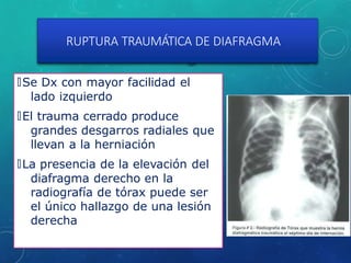 RUPTURA TRAUMÁTICA DE DIAFRAGMA
🞇Se Dx con mayor facilidad el
lado izquierdo
🞇El trauma cerrado produce
grandes desgarros radiales que
llevan a la herniación
🞇La presencia de la elevación del
diafragma derecho en la
radiografía de tórax puede ser
el único hallazgo de una lesión
derecha
 