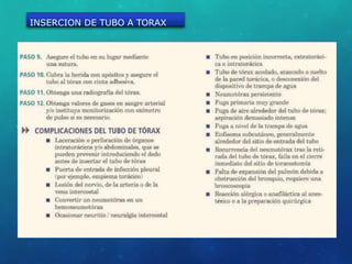 INSERCION DE TUBO A TORAX
 