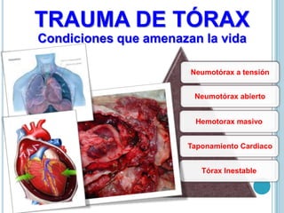 TRAUMA DE TÓRAX
Condiciones que amenazan la vida
Neumotórax a tensión
Neumotórax abierto
Tórax Inestable
Hemotorax masivo
Taponamiento Cardiaco
 