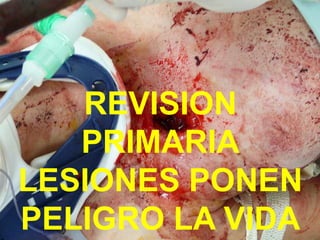 REVISION
PRIMARIA
LESIONES PONEN
PELIGRO LA VIDA
 