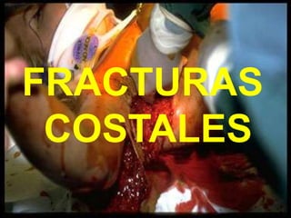 FRACTURAS
COSTALES
 