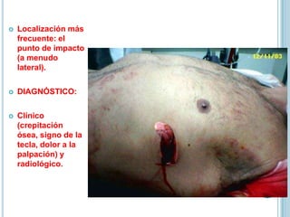  Localización más
frecuente: el
punto de impacto
(a menudo
lateral).
 DIAGNÓSTICO:
 Clínico
(crepitación
ósea, signo de la
tecla, dolor a la
palpación) y
radiológico.
 