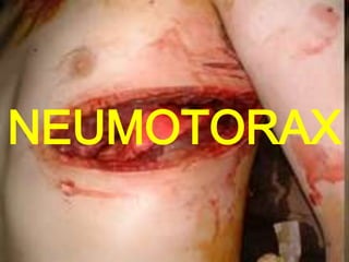 NEUMOTORAX
 