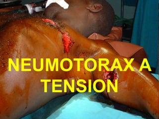 NEUMOTORAX A
TENSION
 