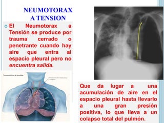 NEUMOTORAX
A TENSION
 El Neumotorax a
Tensión se produce por
trauma cerrado o
penetrante cuando hay
aire que entra al
espacio pleural pero no
encuentra salida.
Que da lugar a una
acumulación de aire en el
espacio pleural hasta llevarlo
a una gran presión
positiva, lo que lleva a un
colapso total del pulmón.
 