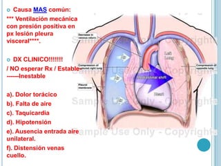  Causa MAS común:
*** Ventilación mecánica
con presión positiva en
px lesión pleura
visceral****.
 DX CLINICO!!!!!!!
/ NO esperar Rx / Estable-
------Inestable
a). Dolor torácico
b). Falta de aire
c). Taquicardia
d). Hipotensión
e). Ausencia entrada aire
unilateral.
f). Distensión venas
cuello.
 