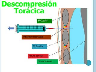 2º Espacio intercostal
2ª Costilla
3ª Costilla
Pleura parietal
Pleura Visceral
Descompresión
Torácica
 