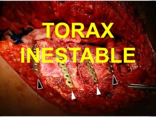 TORAX
INESTABLE
 