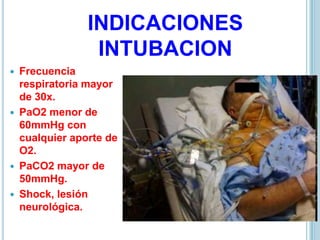 Frecuencia
respiratoria mayor
de 30x.
 PaO2 menor de
60mmHg con
cualquier aporte de
O2.
 PaCO2 mayor de
50mmHg.
 Shock, lesión
neurológica.
INDICACIONES
INTUBACION
 