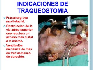 INDICACIONES DE
TRAQUEOSTOMIA
 Fractura grave
maxilofacial.
 Obstrucción de la
vía aérea superior
que requiera un
acceso más distal
a la misma.
 Ventilación
mecánica de más
de tres semanas
de duración.
 