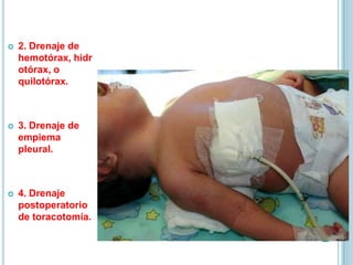  2. Drenaje de
hemotórax, hidr
otórax, o
quilotórax.
 3. Drenaje de
empiema
pleural.
 4. Drenaje
postoperatorio
de toracotomía.
 