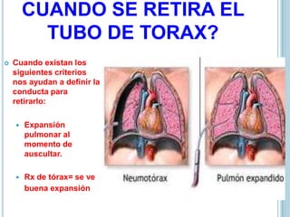 CUANDO SE RETIRA EL
TUBO DE TORAX?
 Cuando existan los
siguientes criterios
nos ayudan a definir la
conducta para
retirarlo:
 Expansión
pulmonar al
momento de
auscultar.
 Rx de tórax= se ve
buena expansión.
 