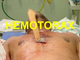 HEMOTORAX
 