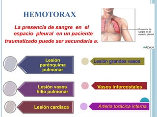 HEMOTORAX
La presencia de sangre en el
espacio pleural en un paciente
traumatizado puede ser secundaria a:
Lesión
parénquima
pulmonar
Lesión vasos
hilio pulmonar
Lesión cardiaca
Lesión grandes vasos
Vasos intercostales
Arteria torácica interna
 