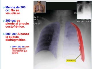 Menos de 200
cc: No se
visualizan
 200 cc: se
pierde al ángulo
costofrénico.
 500 cc: Alcanza
la cúpula
diafragmática.
 200 - 250 cc: por
cada espacio
intercostal que
cubra.
 