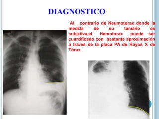 DIAGNOSTICO
Al contrario de Neumotorax donde la
medida de su tamaño es
subjetiva,el Hemotorax puede ser
cuantificado con bastante aproximación
a través de la placa PA de Rayos X de
Tórax
 