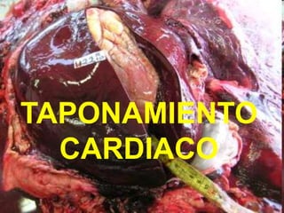TAPONAMIENTO
CARDIACO
 
